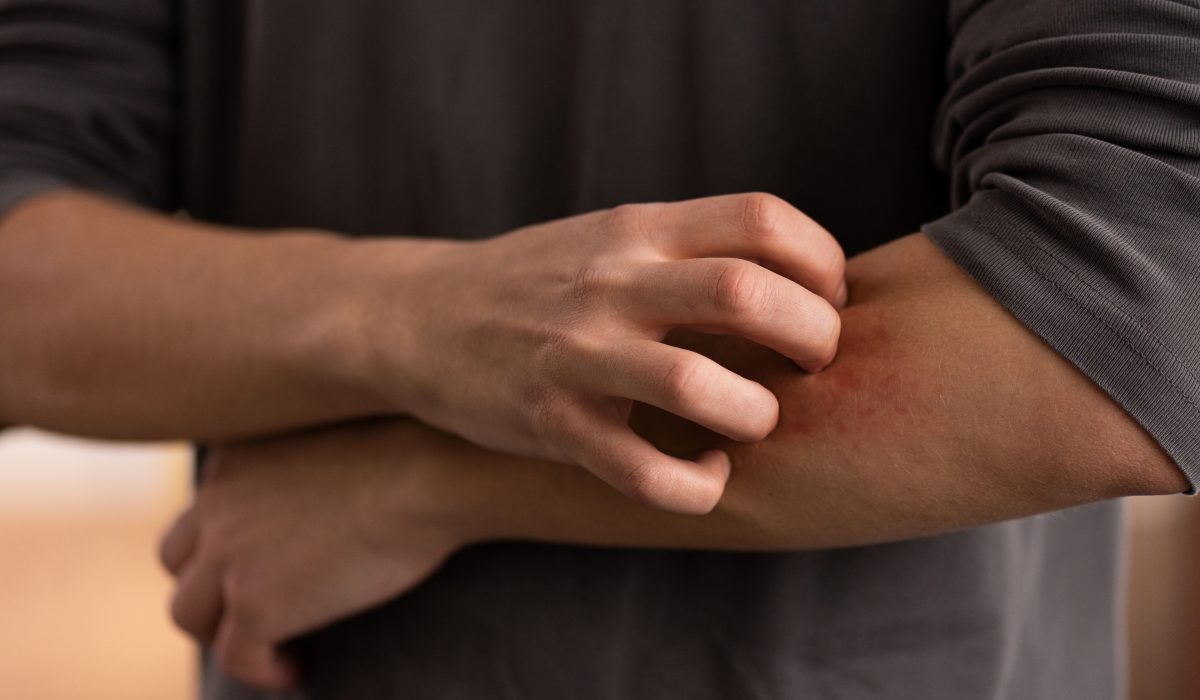 person-dealing-with-rosacea